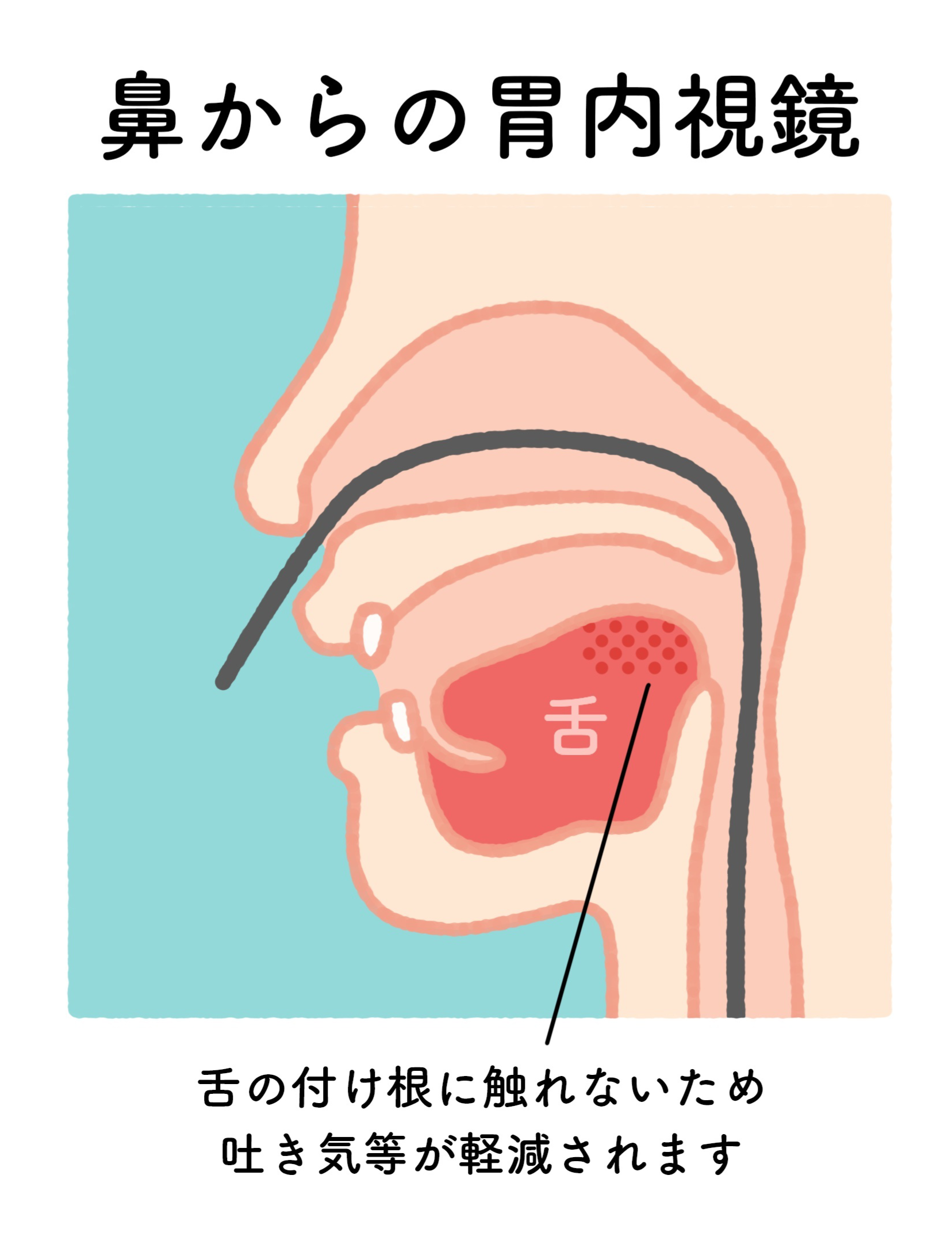 経鼻内視鏡検査のイメージ