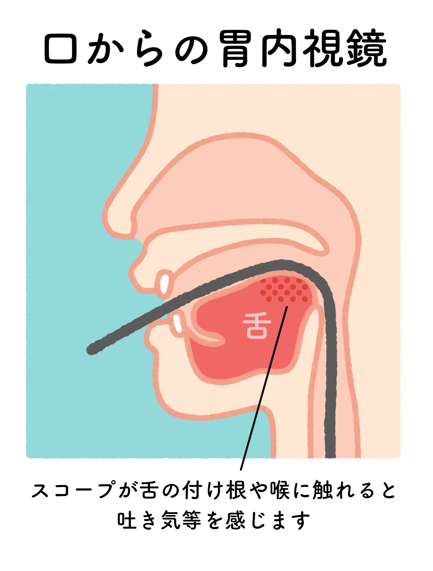 経口内視鏡検査のイメージ
